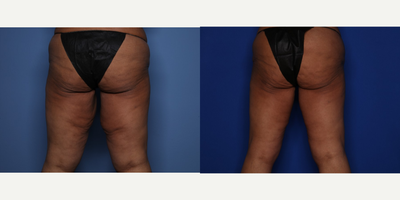 Case 7046 - 35-44 year old woman treated with Thigh Lift