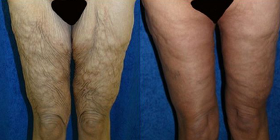 Case 7049 - 55-64 year old woman treated with Thigh Lift