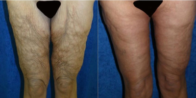 Case 7050 - 55-64 year old woman treated with Thigh Lift