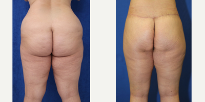 Case 7051 - 35-44 year old woman treated with Thigh Lift