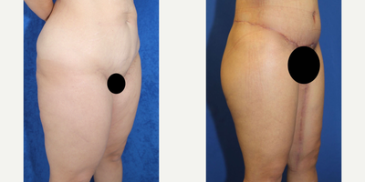 Case 7052 - 35-44 year old woman treated with Thigh Lift