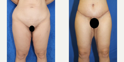 Case 7053 - 35-44 year old woman treated with Thigh Lift