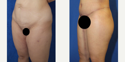 Case 7054 - 35-44 year old woman treated with Thigh Lift