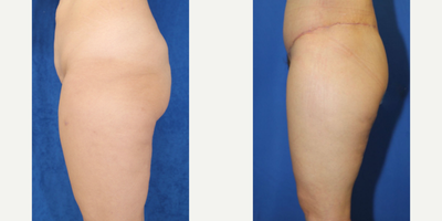 Case 7055 - 35-44 year old woman treated with Thigh Lift