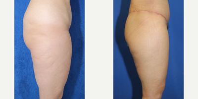 Case 7056 - 35-44 year old woman treated with Thigh Lift