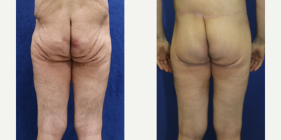 Case 7057 - 35-44 year old man treated with Thigh Lift