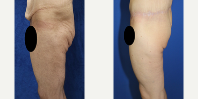 Case 7058 - 35-44 year old man treated with Thigh Lift