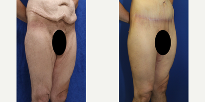 Case 7059 - 35-44 year old man treated with Thigh Lift