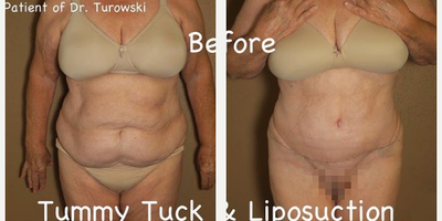 Case 706 - Woman treated with Tummy Tuck