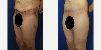 Case 7060 - 35-44 year old man treated with Thigh Lift