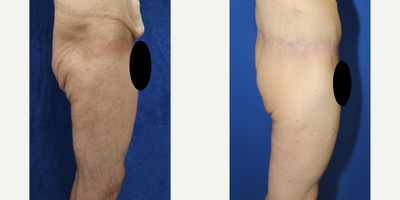 Case 7061 - 35-44 year old man treated with Thigh Lift