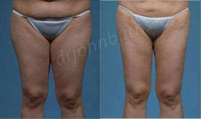 Case 7062 - Woman treated with Thigh Lift