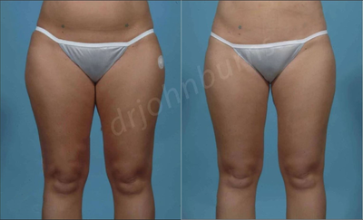 Case 7063 - Woman treated with Thigh Lift