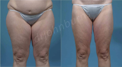 Case 7064 - Woman treated with Thigh Lift