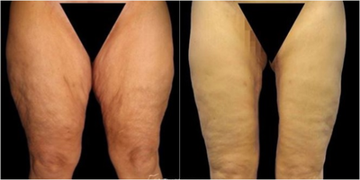Case 7066 - Woman treated with Thigh Lift