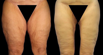 Case 7067 - Woman in her 50's treated with Thigh Lift