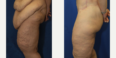 Case 7068 - 45-54 year old woman treated with Thigh Lift