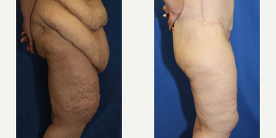 Case 7069 - 45-54 year old woman treated with Thigh Lift
