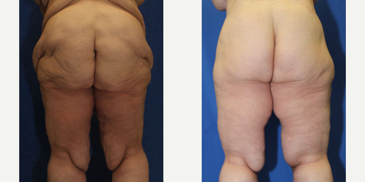 Case 7070 - 45-54 year old woman treated with Thigh Lift