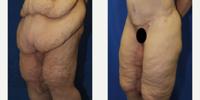 Case 7071 - 45-54 year old woman treated with Thigh Lift