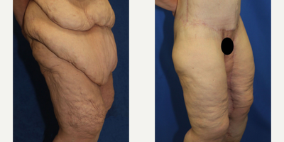 Case 7072 - 45-54 year old woman treated with Thigh Lift