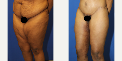 Case 7073 - 25-34 year old woman treated with Thigh Lift