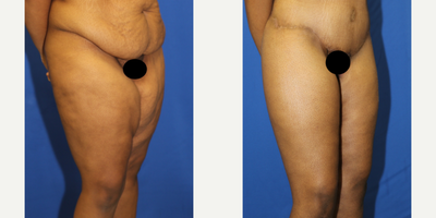 Case 7074 - 25-34 year old woman treated with Thigh Lift