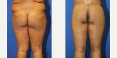 Case 7075 - 25-34 year old woman treated with Thigh Lift