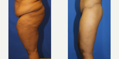 Case 7076 - 25-34 year old woman treated with Thigh Lift