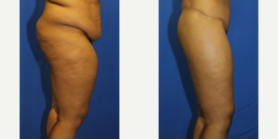 Case 7077 - 25-34 year old woman treated with Thigh Lift