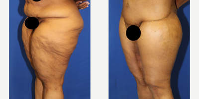 Case 7078 - 55-64 year old woman treated with Thigh Lift