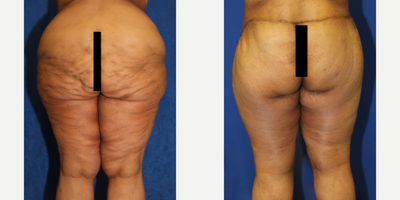 Case 7079 - 55-64 year old woman treated with Thigh Lift