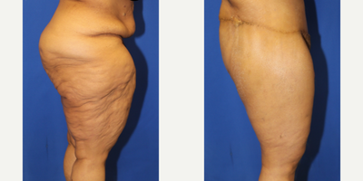 Case 7080 - 55-64 year old woman treated with Thigh Lift