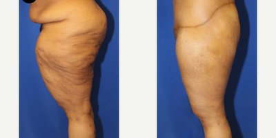 Case 7081 - 55-64 year old woman treated with Thigh Lift