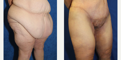 Case 7082 - 45-54 year old woman treated with Thigh Lift