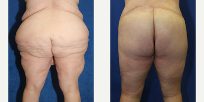 Case 7083 - 45-54 year old woman treated with Thigh Lift