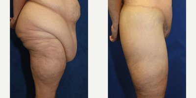 Case 7084 - 45-54 year old woman treated with Thigh Lift