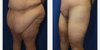 Case 7085 - 45-54 year old woman treated with Thigh Lift