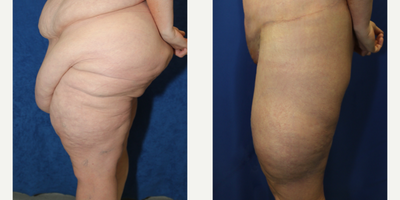 Case 7086 - 45-54 year old woman treated with Thigh Lift