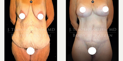 Case 7087 - Woman treated with Thigh Lift