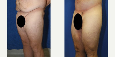 Case 7088 - 25-34 year old man treated with Thigh Lift