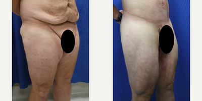 Case 7089 - 25-34 year old man treated with Thigh Lift