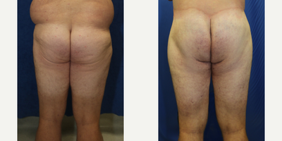 Case 7090 - 25-34 year old man treated with Thigh Lift