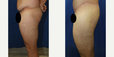 Case 7091 - 25-34 year old man treated with Thigh Lift