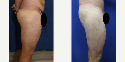 Case 7092 - 25-34 year old man treated with Thigh Lift