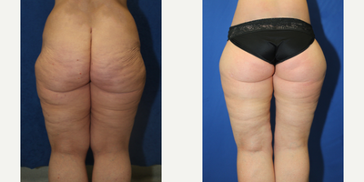 Case 7093 - 55-64 year old woman treated with Thigh Lift