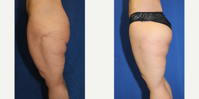 Case 7094 - 55-64 year old woman treated with Thigh Lift