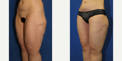 Case 7095 - 55-64 year old woman treated with Thigh Lift