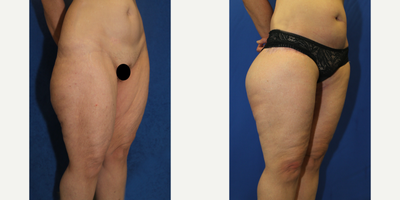 Case 7096 - 55-64 year old woman treated with Thigh Lift