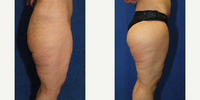 Case 7097 - 55-64 year old woman treated with Thigh Lift
